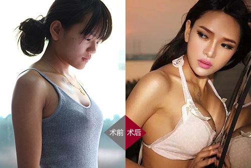 岑苑之假体隆胸前后对比